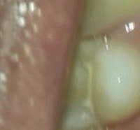 a close up of a person's mouth with a tooth