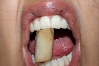 a close up of a woman's mouth with a tooth in it